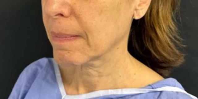Neck Lift before at Moy, Fincher, Chipps Facial Plastics & Dermatology - Beverly Hills in Beverly Hills, CA