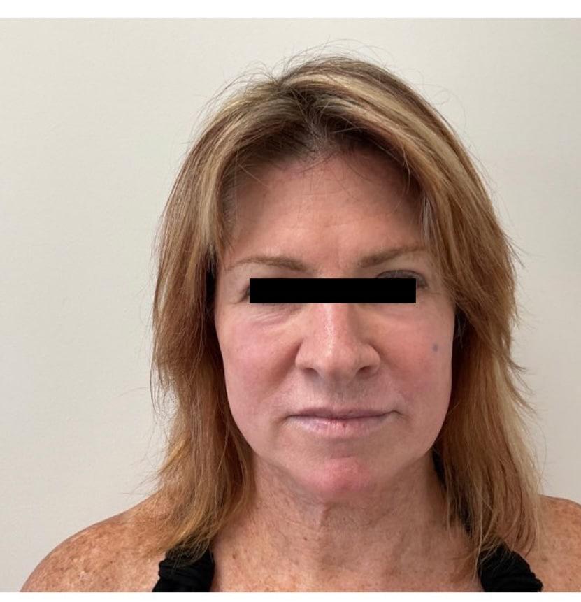 Moy, Fincher, Chipps Facial Plastics & Dermatology - Beverly Hills laser treatment after — Beverly Hills, CA