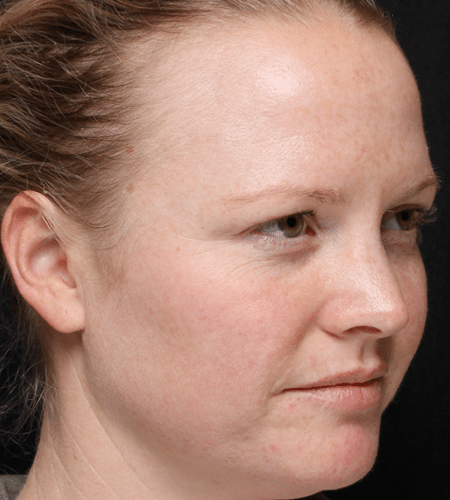 Laser Skin Resurfacing after at Moy, Fincher, Chipps Facial Plastics & Dermatology - Beverly Hills in Beverly Hills, CA