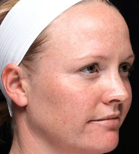 Laser Skin Resurfacing before at Moy, Fincher, Chipps Facial Plastics & Dermatology - Beverly Hills in Beverly Hills, CA