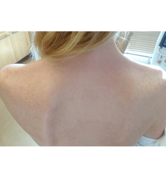 Moy, Fincher, Chipps Facial Plastics & Dermatology - Beverly Hills laser treatment after — Beverly Hills, CA
