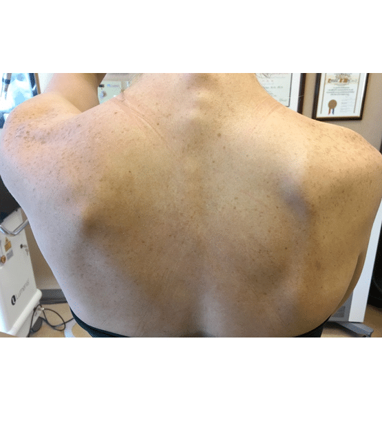 Laser Skin Resurfacing before at Moy, Fincher, Chipps Facial Plastics & Dermatology - Beverly Hills in Beverly Hills, CA
