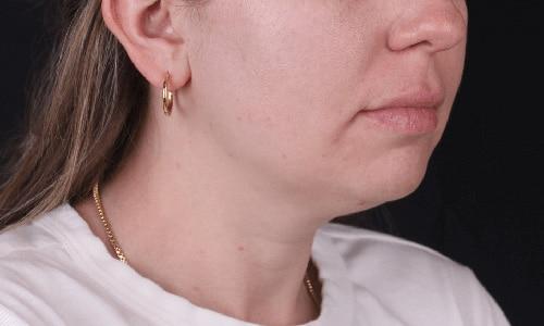 Neck Liposuction before at Moy, Fincher, Chipps Facial Plastics & Dermatology - Beverly Hills in Beverly Hills, CA