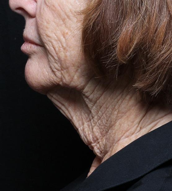 Neck Lift before at Moy, Fincher, Chipps Facial Plastics & Dermatology - Beverly Hills in Beverly Hills, CA