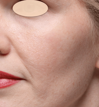 Laser Skin Resurfacing after at Moy, Fincher, Chipps Facial Plastics & Dermatology - Beverly Hills in Beverly Hills, CA