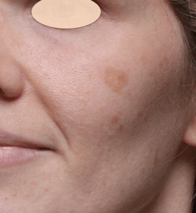 Laser Skin Resurfacing before at Moy, Fincher, Chipps Facial Plastics & Dermatology - Beverly Hills in Beverly Hills, CA