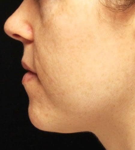 Moy, Fincher, Chipps Facial Plastics & Dermatology - Beverly Hills neck liposuction after — Beverly Hills, CA