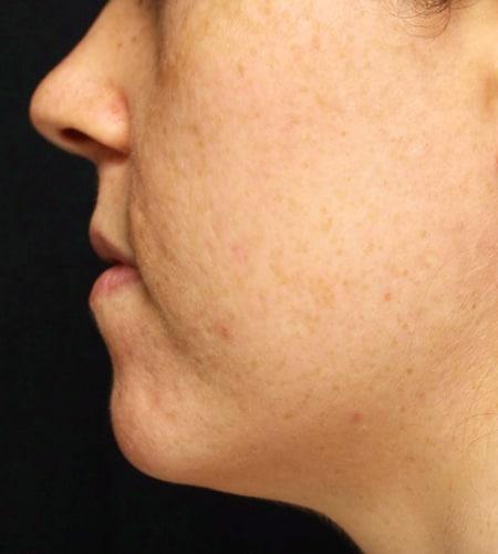 Neck Liposuction before at Moy, Fincher, Chipps Facial Plastics & Dermatology - Beverly Hills in Beverly Hills, CA