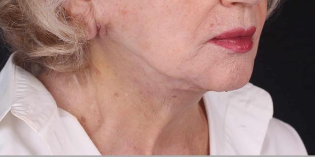 Neck Lift after at Moy, Fincher, Chipps Facial Plastics & Dermatology - Beverly Hills in Beverly Hills, CA