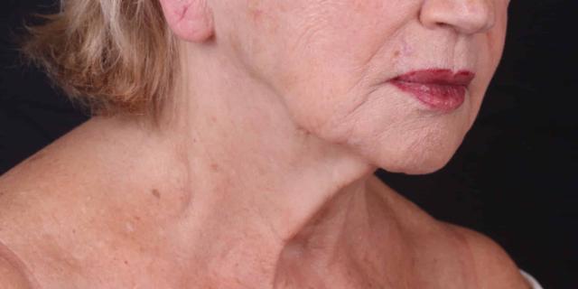 Neck Lift before at Moy, Fincher, Chipps Facial Plastics & Dermatology - Beverly Hills in Beverly Hills, CA
