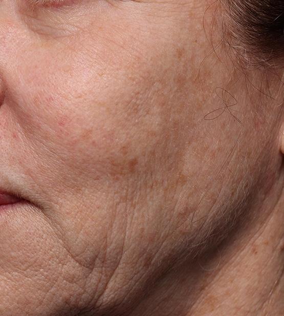 Moy, Fincher, Chipps Facial Plastics & Dermatology - Beverly Hills after — Beverly Hills, CA