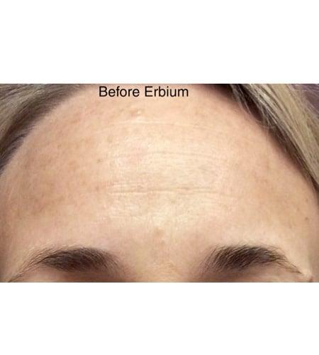 Laser Skin Resurfacing before at Moy, Fincher, Chipps Facial Plastics & Dermatology - Beverly Hills in Beverly Hills, CA