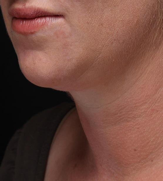 Liposuction after at Moy, Fincher, Chipps Facial Plastics & Dermatology - Beverly Hills in Beverly Hills, CA