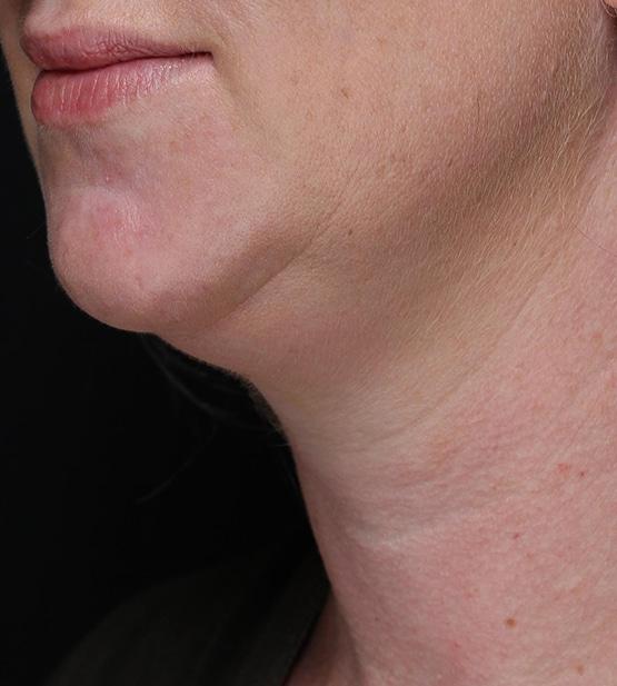 Liposuction before at Moy, Fincher, Chipps Facial Plastics & Dermatology - Beverly Hills in Beverly Hills, CA