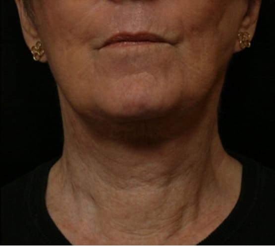 Neck Lift after at Moy, Fincher, Chipps Facial Plastics & Dermatology - Beverly Hills in Beverly Hills, CA