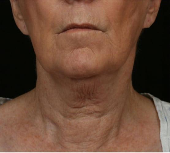 Neck Lift before at Moy, Fincher, Chipps Facial Plastics & Dermatology - Beverly Hills in Beverly Hills, CA