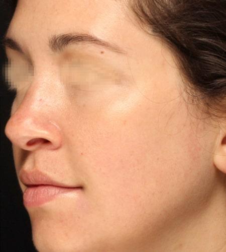 Functional Rhinoplasty after at Moy, Fincher, Chipps Facial Plastics & Dermatology - Beverly Hills in Beverly Hills, CA