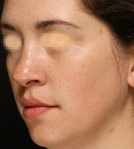 Functional Rhinoplasty before at Moy, Fincher, Chipps Facial Plastics & Dermatology - Beverly Hills in Beverly Hills, CA