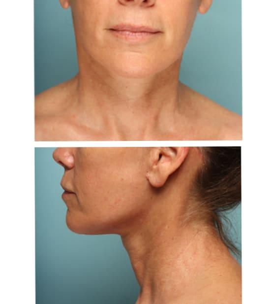 Neck Lift after at Moy, Fincher, Chipps Facial Plastics & Dermatology - Beverly Hills in Beverly Hills, CA