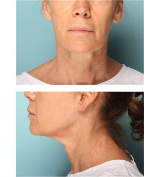 Neck Lift before at Moy, Fincher, Chipps Facial Plastics & Dermatology - Beverly Hills in Beverly Hills, CA