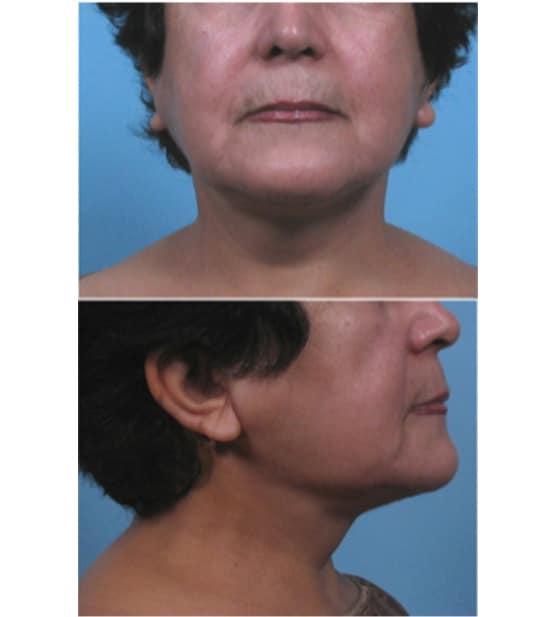 Facelift after at Moy, Fincher, Chipps Facial Plastics & Dermatology - Beverly Hills in Beverly Hills, CA