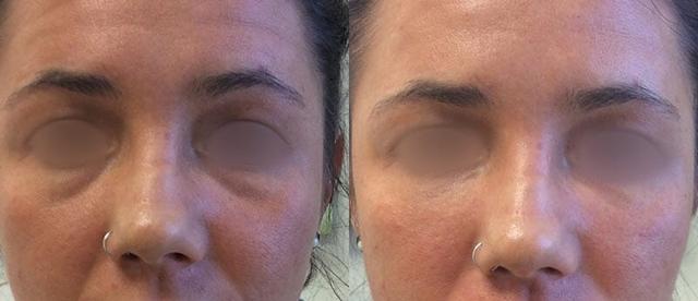 Juvederm result at The Cosmetic Surgery Center in Independence, OH