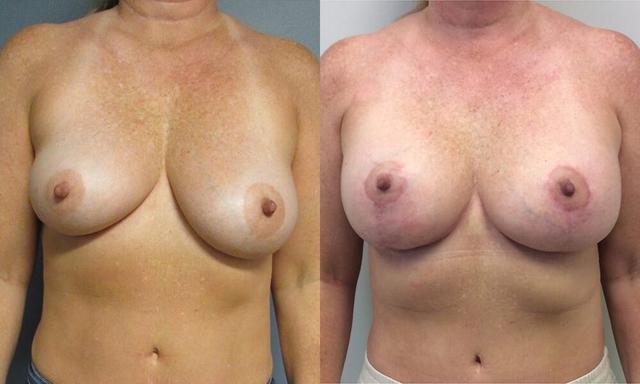 Breast Lift result at The Cosmetic Surgery Center in Independence, OH