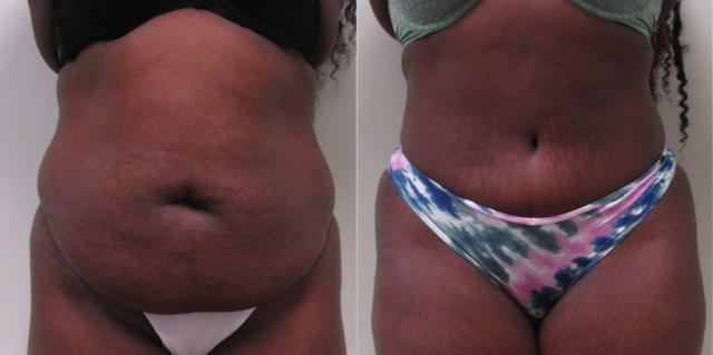 Tummy Tuck result at The Cosmetic Surgery Center in Independence, OH