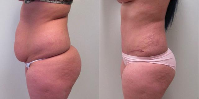 Tummy Tuck result at The Cosmetic Surgery Center in Independence, OH