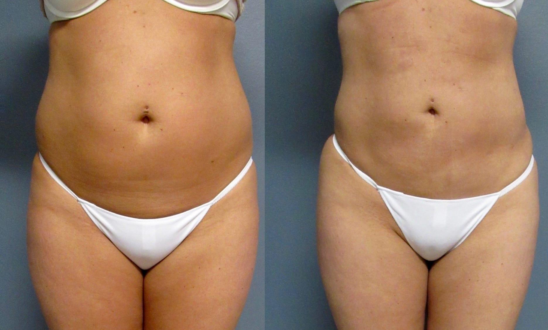 The Cosmetic Surgery Center liposuction result — Independence, OH