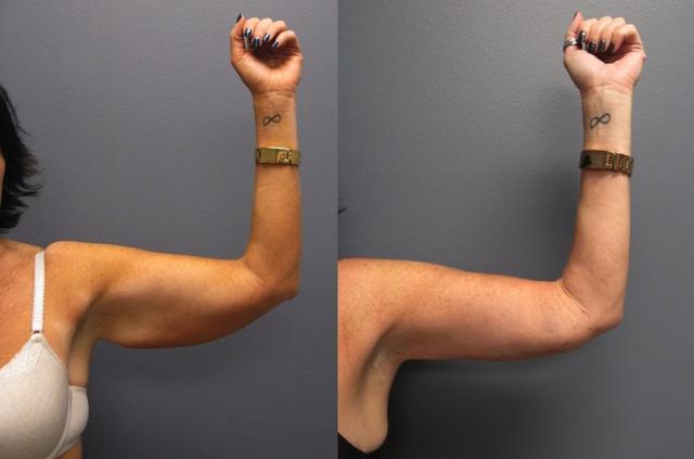 CoolSculpting result at The Cosmetic Surgery Center in Independence, OH