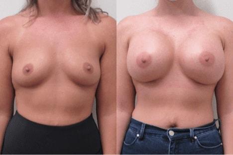 Breast Augmentation result at The Cosmetic Surgery Center in Independence, OH