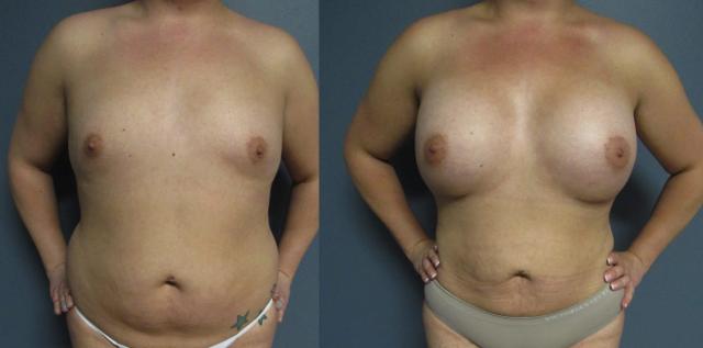 Mommy Makeover result at The Cosmetic Surgery Center in Independence, OH
