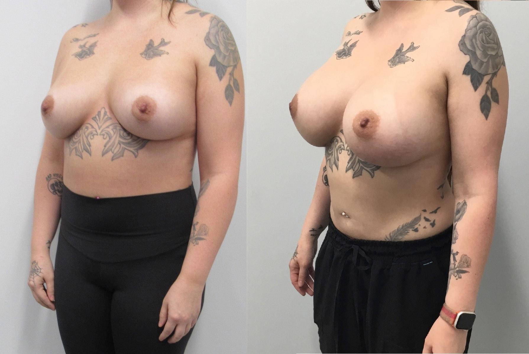 The Cosmetic Surgery Center breast augmentation revision result — Independence, OH