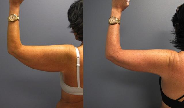 CoolSculpting result at The Cosmetic Surgery Center in Independence, OH