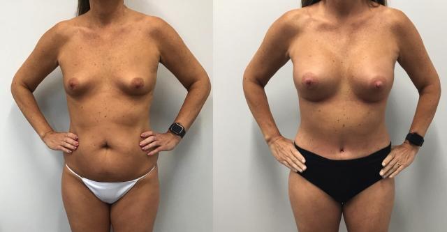 Breast Augmentation result at The Cosmetic Surgery Center in Independence, OH