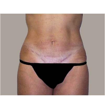 Ivo D. Pestana, MD tummy tuck after — Coral Springs, FL