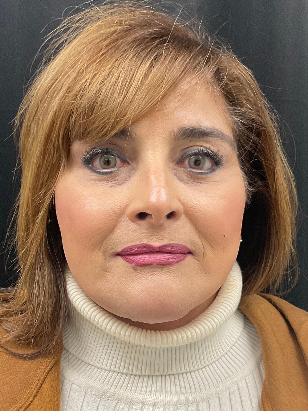 Palm Beach Cosmetic Surgery eyelid lift after — West Palm Beach, FL