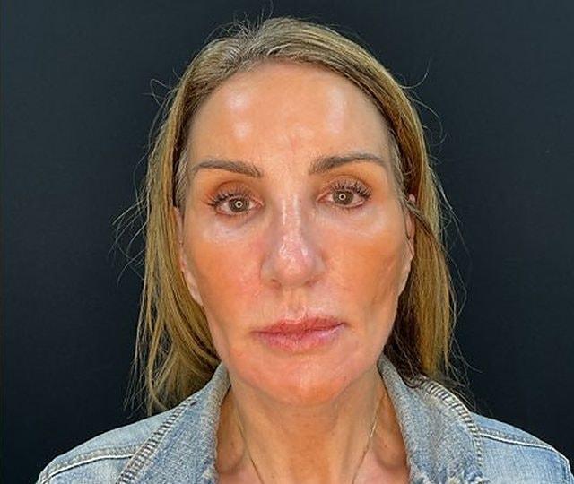 Palm Beach Cosmetic Surgery facelift after — West Palm Beach, FL