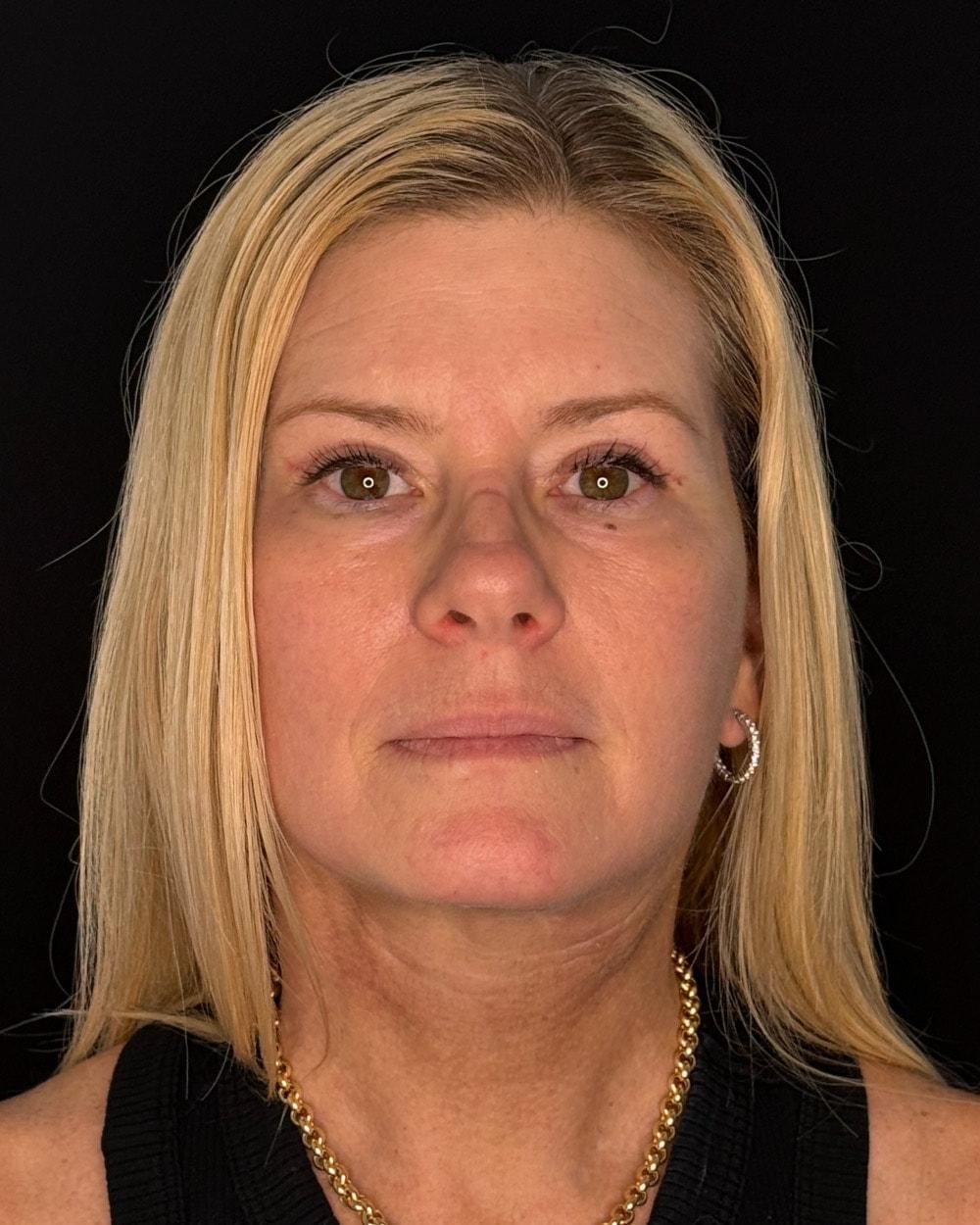Palm Beach Cosmetic Surgery eyelid lift after — West Palm Beach, FL