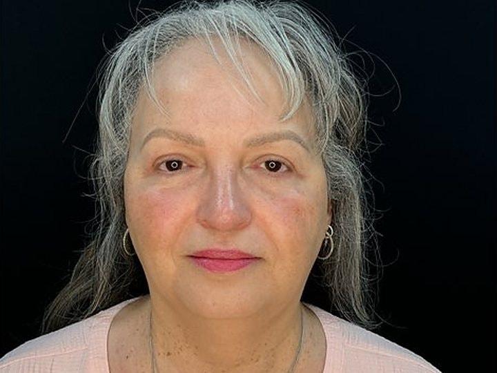 Palm Beach Cosmetic Surgery eyelid lift after — West Palm Beach, FL