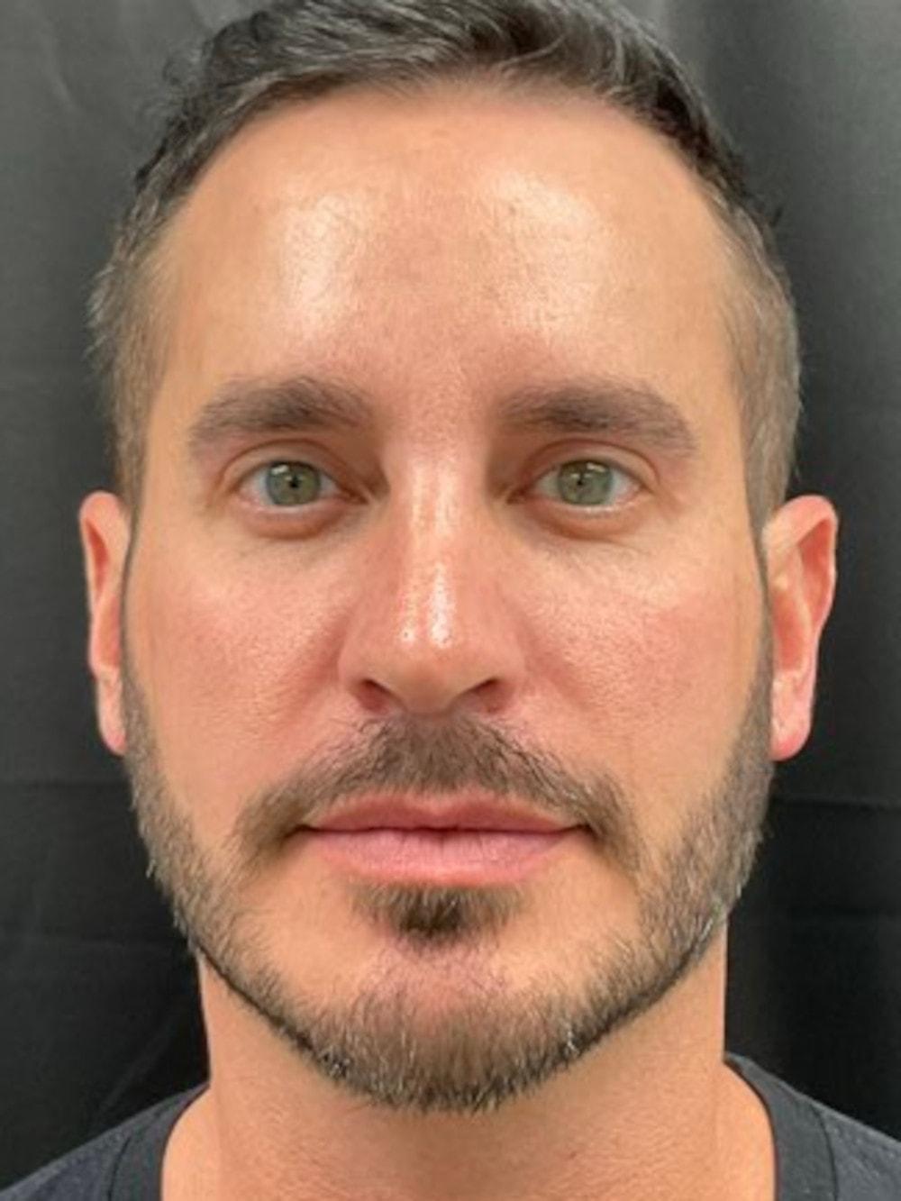 Palm Beach Cosmetic Surgery eyelid lift after — West Palm Beach, FL