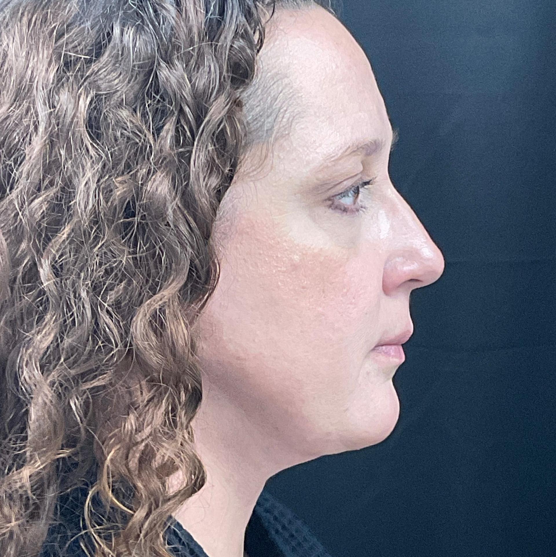 Palm Beach Cosmetic Surgery facelift after — West Palm Beach, FL
