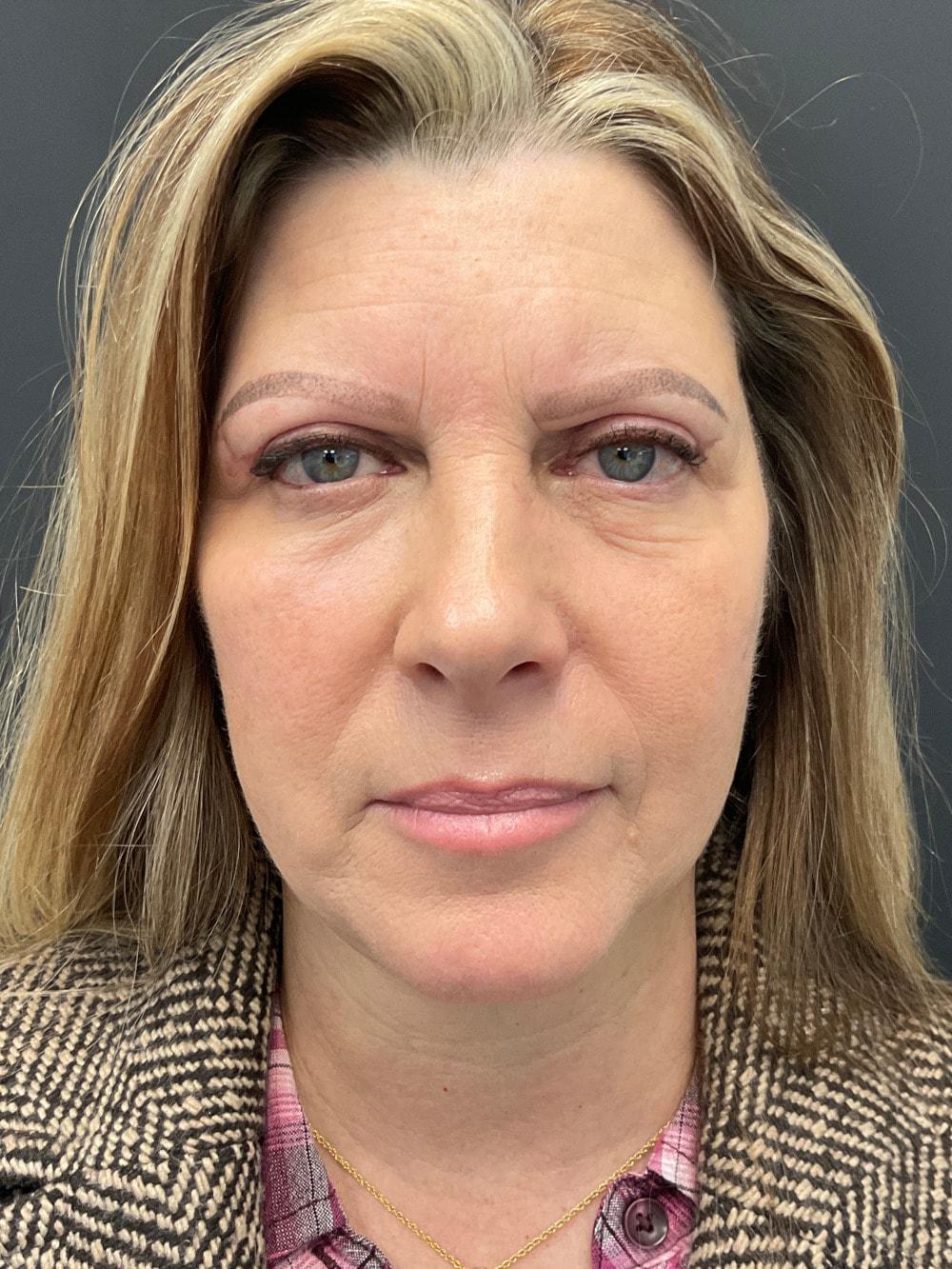 Palm Beach Cosmetic Surgery facelift after — West Palm Beach, FL