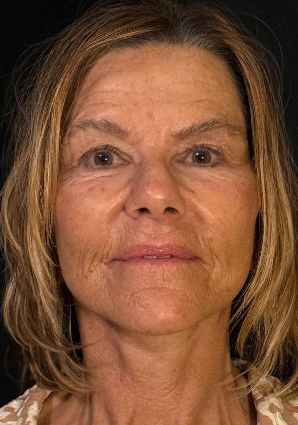 Palm Beach Cosmetic Surgery facelift after — West Palm Beach, FL