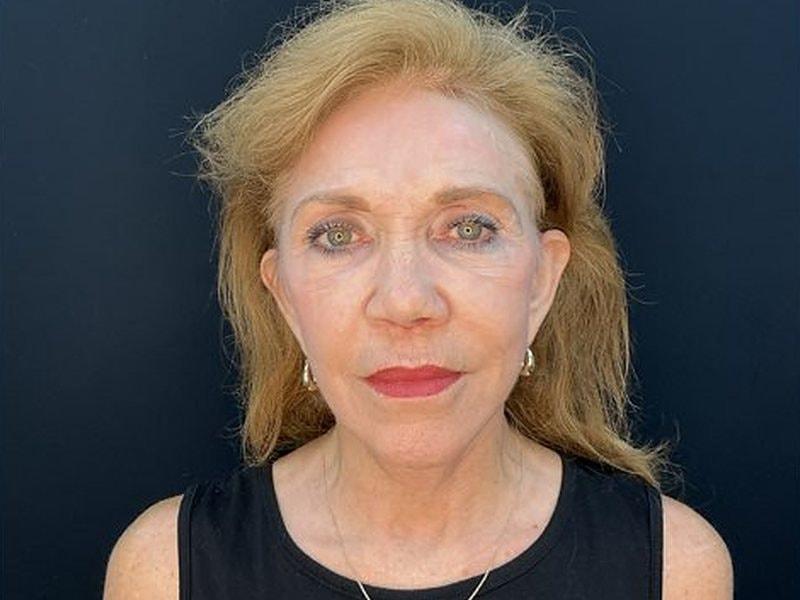 Palm Beach Cosmetic Surgery facelift after — West Palm Beach, FL