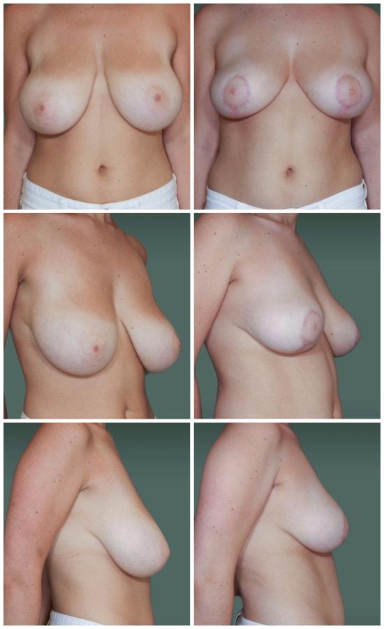 Mark H. Schwartz, MD, FACS breast reduction result — New York, NY