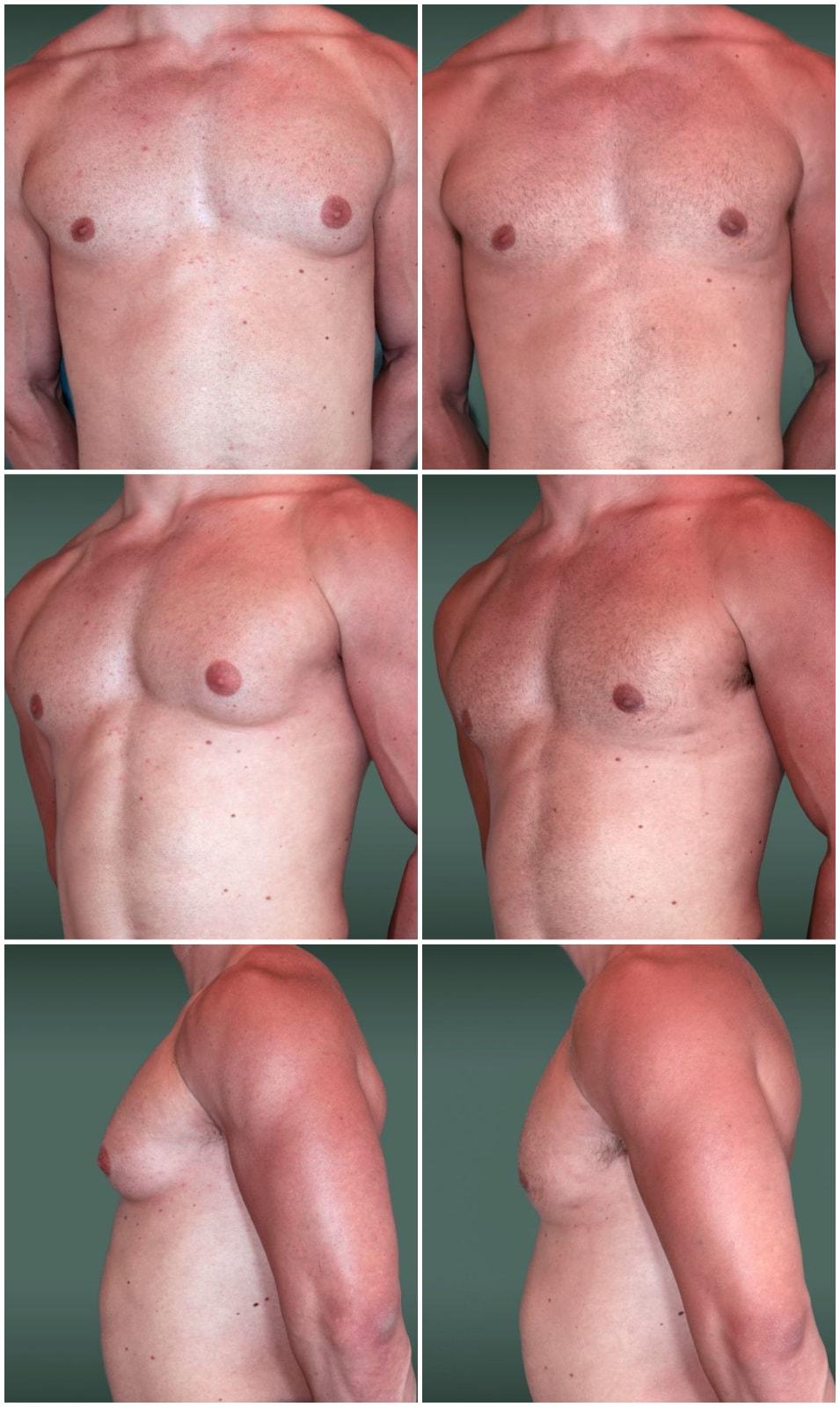 Mark H. Schwartz, MD, FACS gynecomastia result — New York, NY