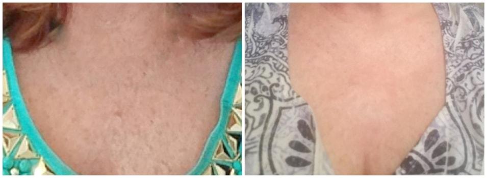 Mark H. Schwartz, MD, FACS laser treatment result — New York, NY