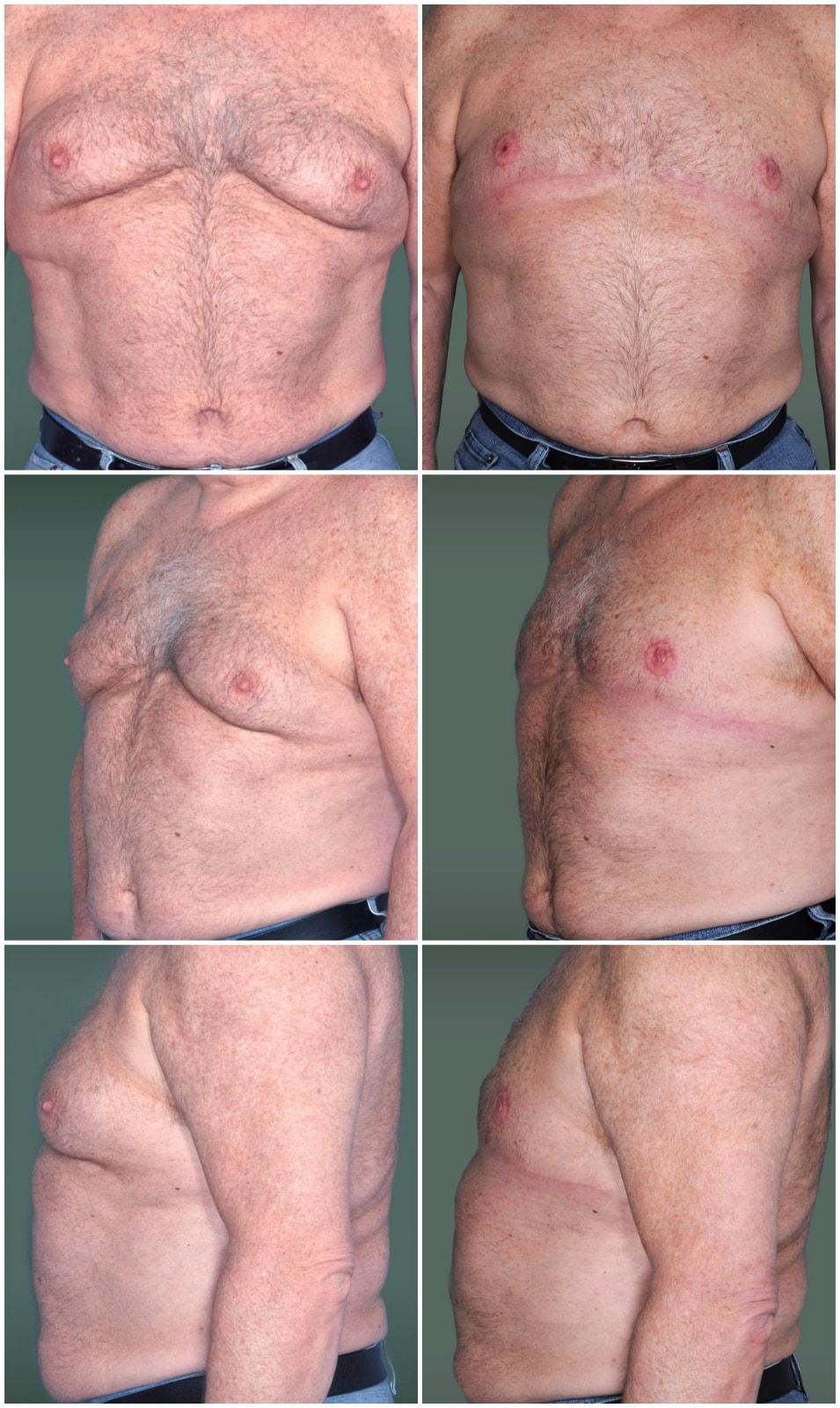 Mark H. Schwartz, MD, FACS gynecomastia result — New York, NY